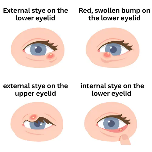 Illustration of four types of stye on the eye, showing external and internal styes on upper and lower eyelids with visible redness and swelling.