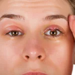 How to Get Rid of a Stye